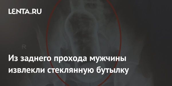Необычный случай в Пакистане с стеклянной бутылкой в прямой кишке